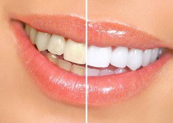 sbiancamento cura dei denti,sbiancamento denti metodi e consigli,come avere i denti bianchi